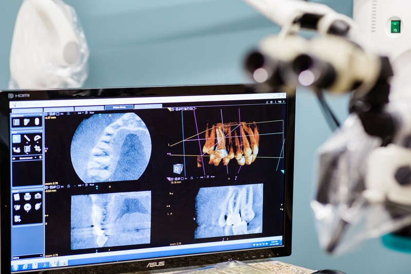 mircroscopic root canal therapy